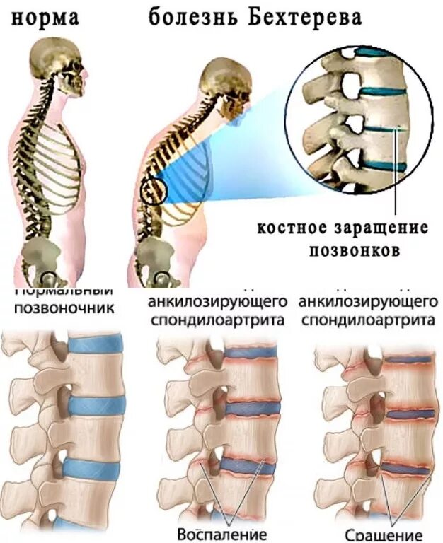 Спондилоартроз дают ли инвалидность