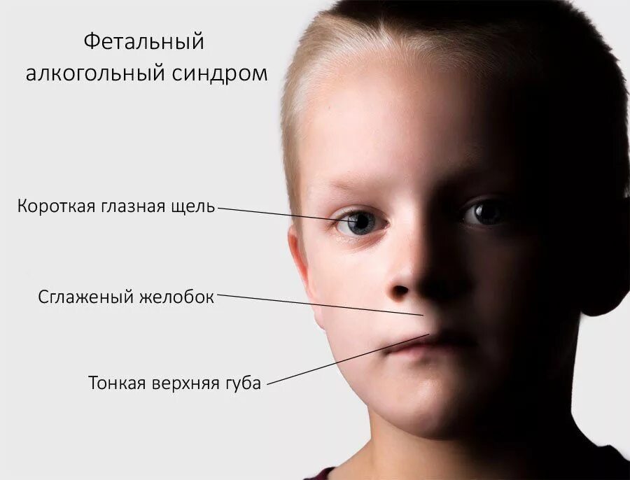Синдром алкогольного ребенка. Фас фетальный алкогольный синдром. фестивальный алкогольный синдром. футбольный алкогольный синдром. фетальный алкогольный синдром плода.