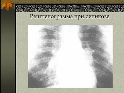 Что такое силикоз
