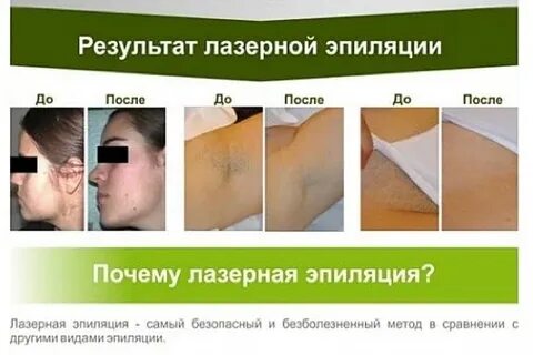 Shr эпиляция отзывы