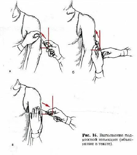 Подкожные инъекции техника выполнения. Постановка инъекций подкожно в плечо. Алгоритм выполнения подкожной инъекции алгоритм. Подкожная инъекция в плечо алгоритм. Алгоритм проведения инъекции в плечо.