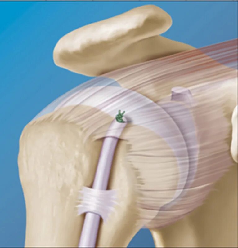 Тенодез сухожилия бицепса. Субпекторальный тенодез длинной головки бицепса фиксатором HEALICOIL. Тенодез плечевого сустава. Тенодез длинной головки.