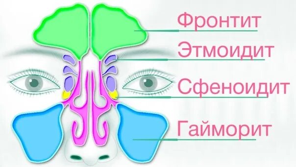 Хронический сфеноидит. Гайморит фронтит синусит этмоидит. Острый этмоидальный синусит симптомы.