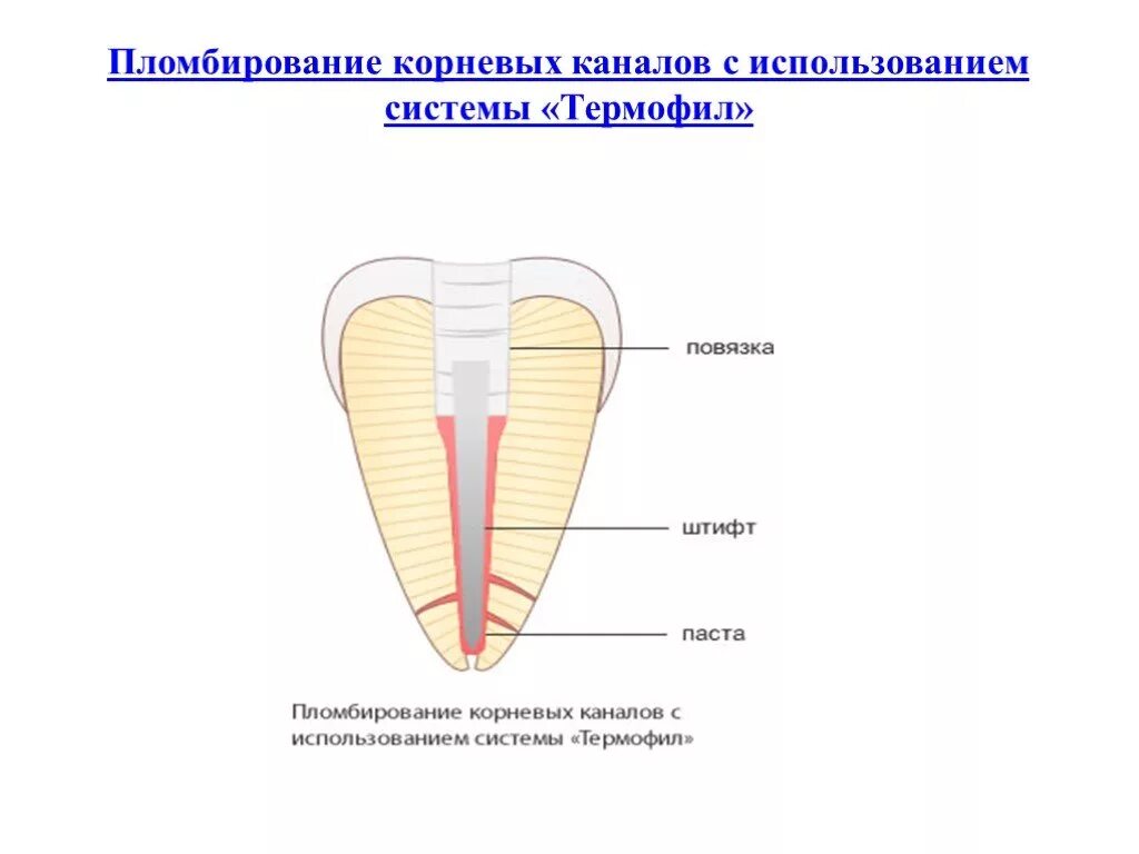 Обработка и пломбирование корневых каналов. Обтурация системы корневых каналов. Термофил методика пломбирования. Пломбировочная система корневых каналов «Термафил».. Штифт для обтурации корневого канала.