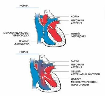 Пороки клапана легочной артерии