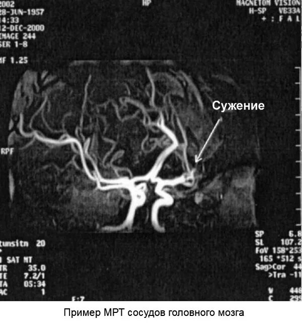 Сосуды головного мозга на мрт стеноз. Кт ангиография сосудов головного мозга. Мрт сужение артерий головного мозга. Патология артерии в головном мозге мрт.