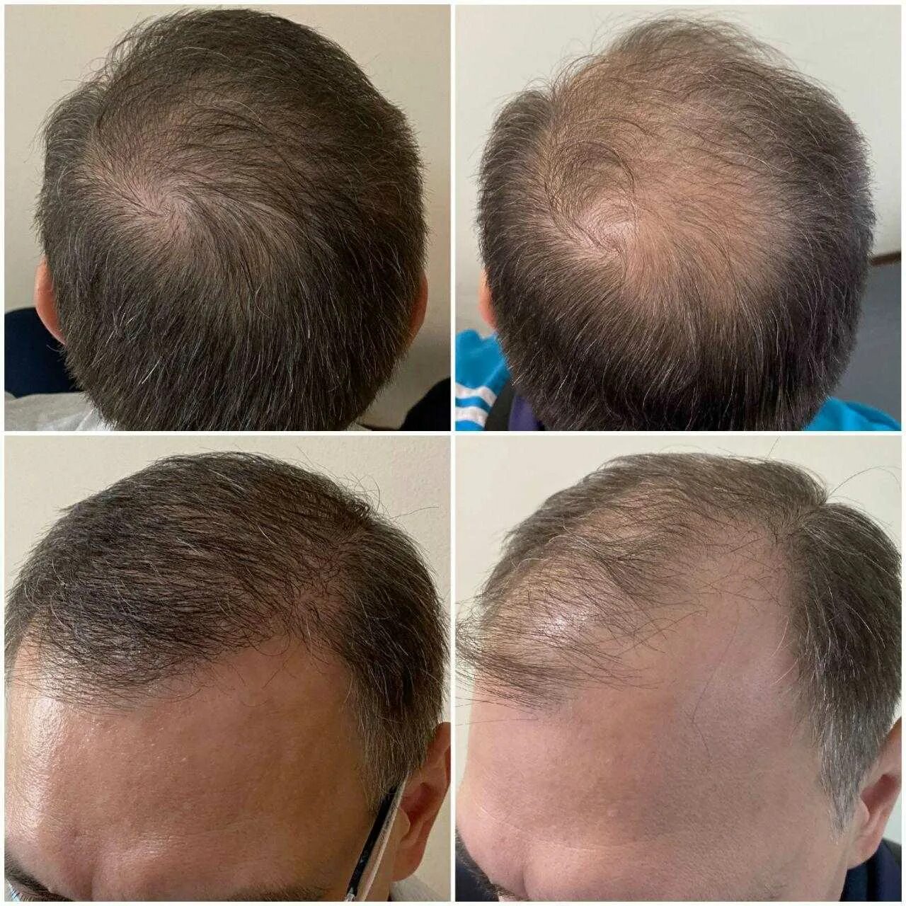 Графт трансплантация волос. Пересадка волос до и после. Трансплантация волос методом fue. Выпадают волосы после пересадки