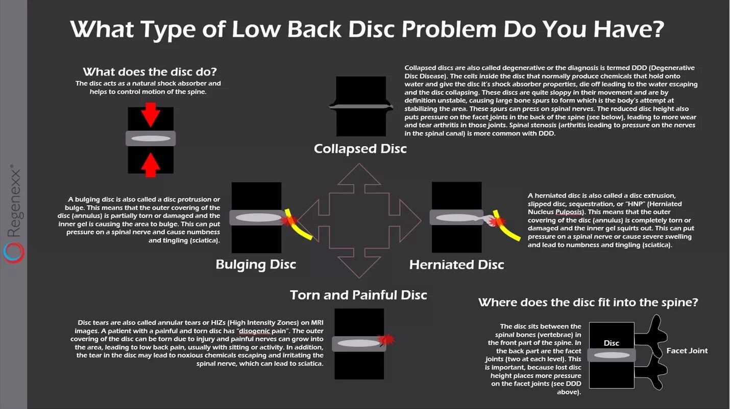 What did the problem be. Disc tear on MRI. How to locate a herniated Disc on MRI. Back Disc. MRI explained: how does it work?.