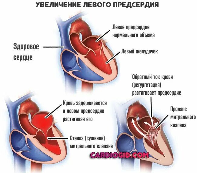 Гипертрофия полостей сердца. Дилатация предсердий. дилатация полостей предсердий. дилатация объемная перегрузка левого предсердия. дилатация левого предсердия.