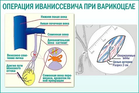 Операция иваниссевича