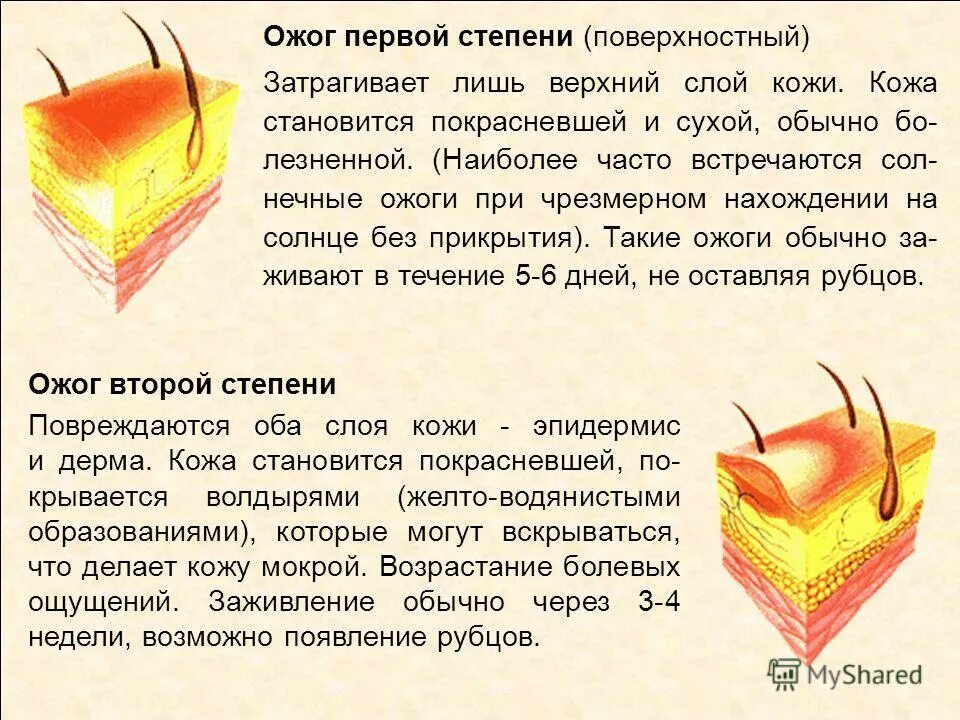 Как долго заживают ожоги 2 степени. При поверхностных ожогах первой степени.