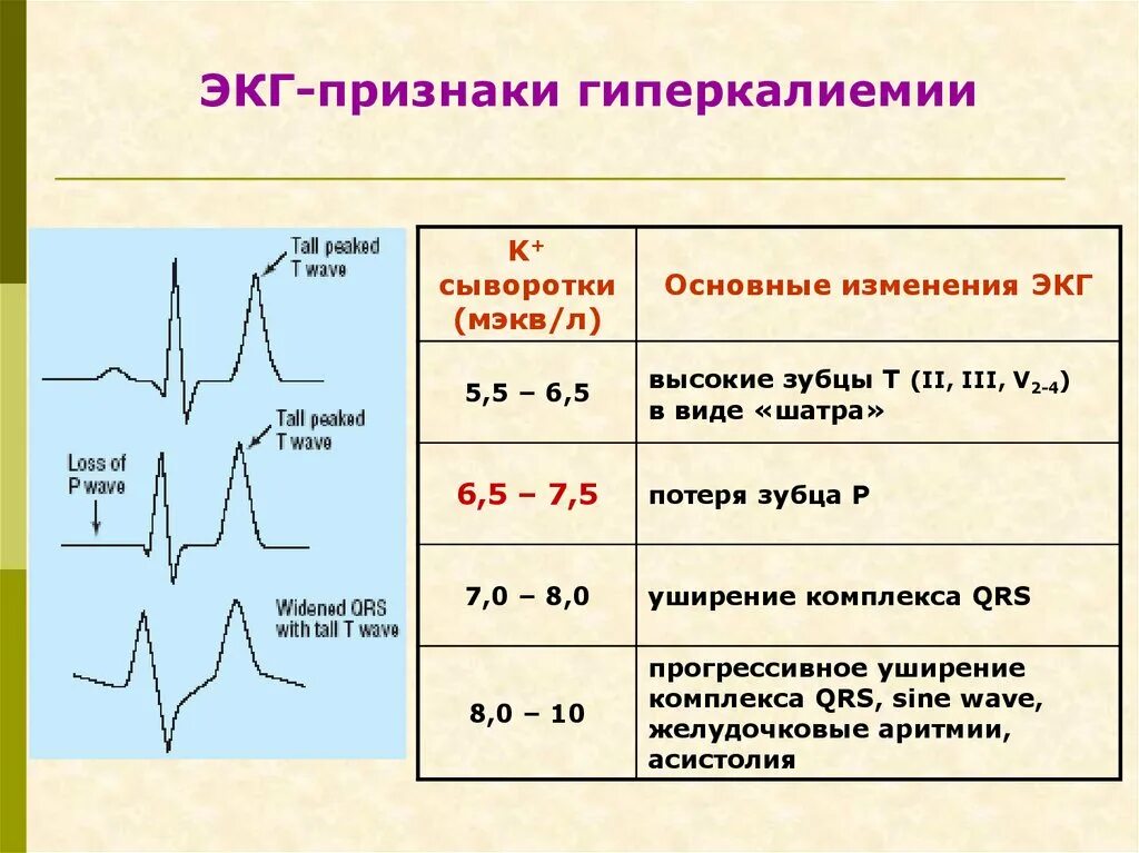 Гиперкалиемия что. Гипокалиемия и гиперкалиемия на ЭКГ. Признаки гиперкалиемии на ЭКГ. ЭКГ критерии гиперкалиемии. ЭКГ зубец т гиперкалиемия.