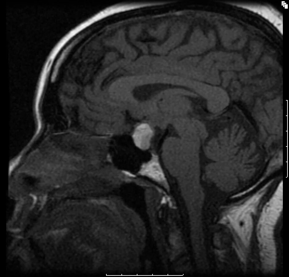 Аденома гипофиз мозга что это такое. Микроаденома гипофиза мрт. Мрт микроаденома гипофиза мрт. Макроадененома гипофиза мрт. Опухоль аденома гипофиза.