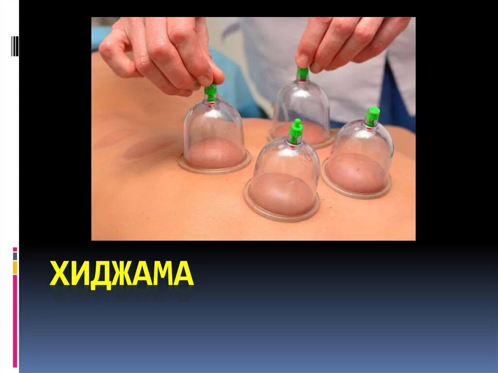 Хиджама банки показания. Вакуумный массаж хиджама. Хиджама кровеиспускание. Моя первая работа хиджама на тело (как красиво писать в инстаграмме ). Хиджама банки показания.