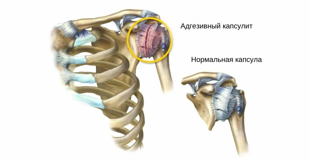 Адгезивный капсулит рентген. Лопаточный периартроз плечевого сустава. Адгезивный капсулит плечелопаточного сустава.