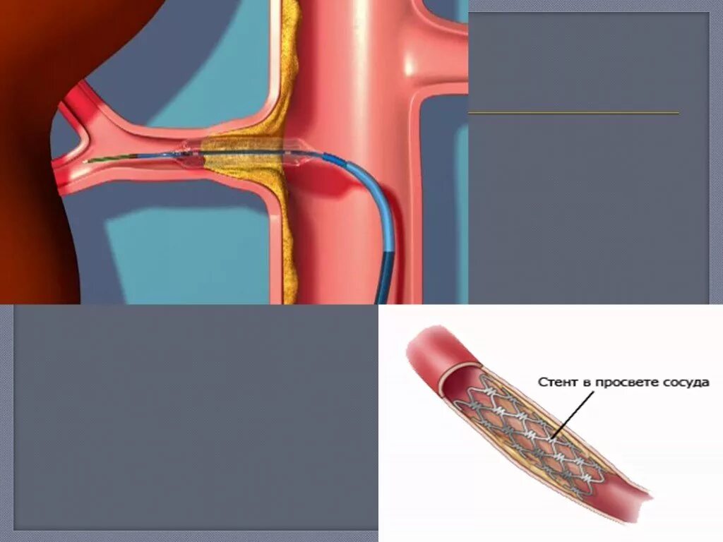 Система стента. Ангиопластика почечных артерий. Стеноз почечной артерии. Атеросклероз почечных артерий. Вазоренальная артериальная гипертензия.