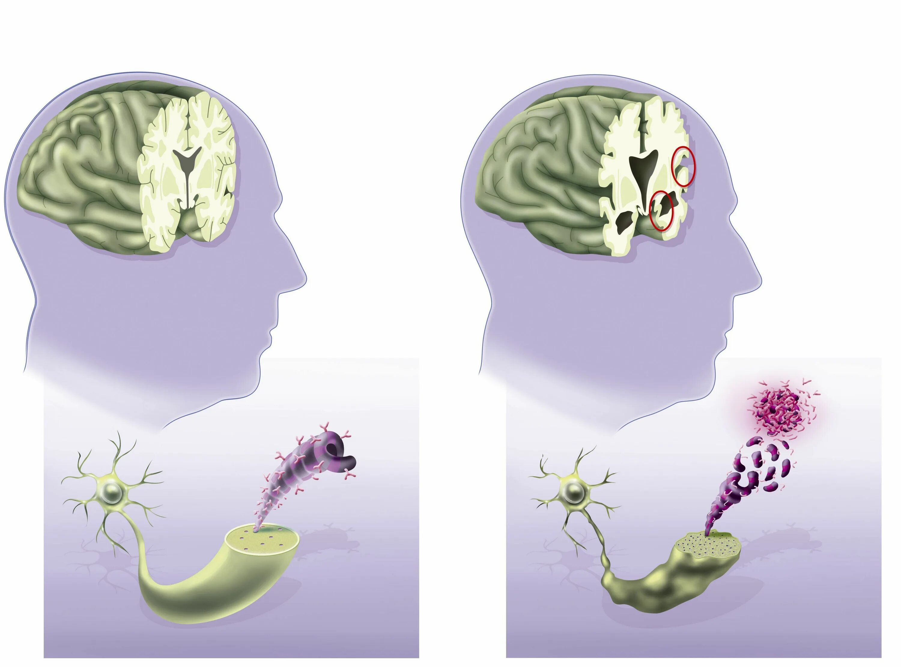 Болезнь Альцгеймера иллюстрация. Мозг больного Альцгеймером. Мозг здоровый и Альцгеймера. Рисунки Альцгеймера. Уилис деменция