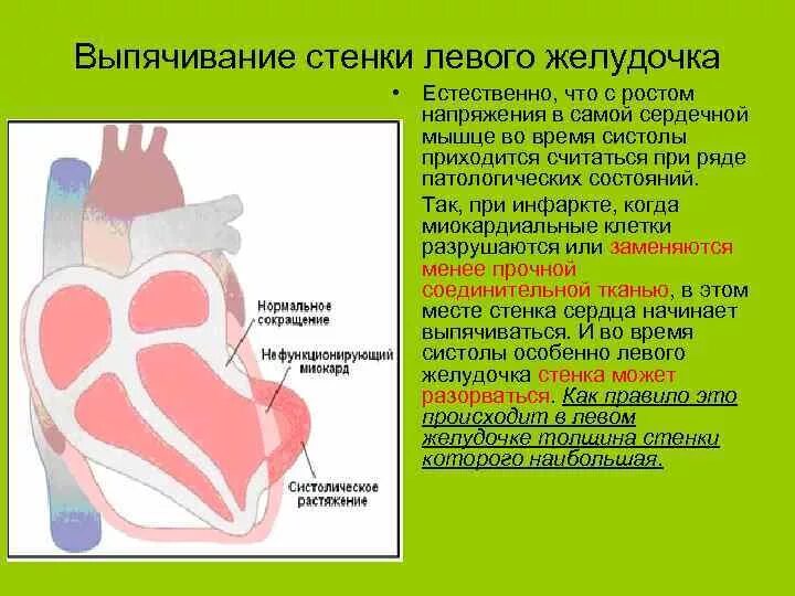 Стенки левого желудочка сердца. Гипокинез левого желудочка. Гипокинез стенок левого желудочка. Задняя нижняя стенка сердца.