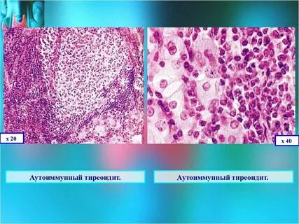 Ответы на тесты тиреоидиты у детей