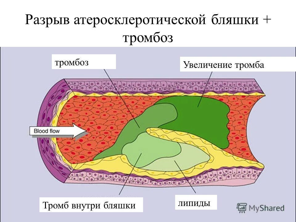 Разрыв бляшки. Атеросклеротическая бляшка. Разрыв атеросклеротической бляшки патогенез.