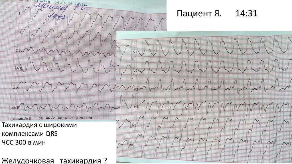 Широкий комплекс qrs. Оим 2 типа. желудочковая тахикардия с широкими комплексами. тахикардия с широкими комплексами qrs. желудочковая тахикардия с широкими комплексами инфаркт.