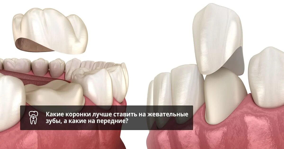 Металлокерамика коронки воспалилась Десна. Коронки для жевательных зубов. Коронки за жевательные зубу. Металлокерамика коронки на жевательные зубы.