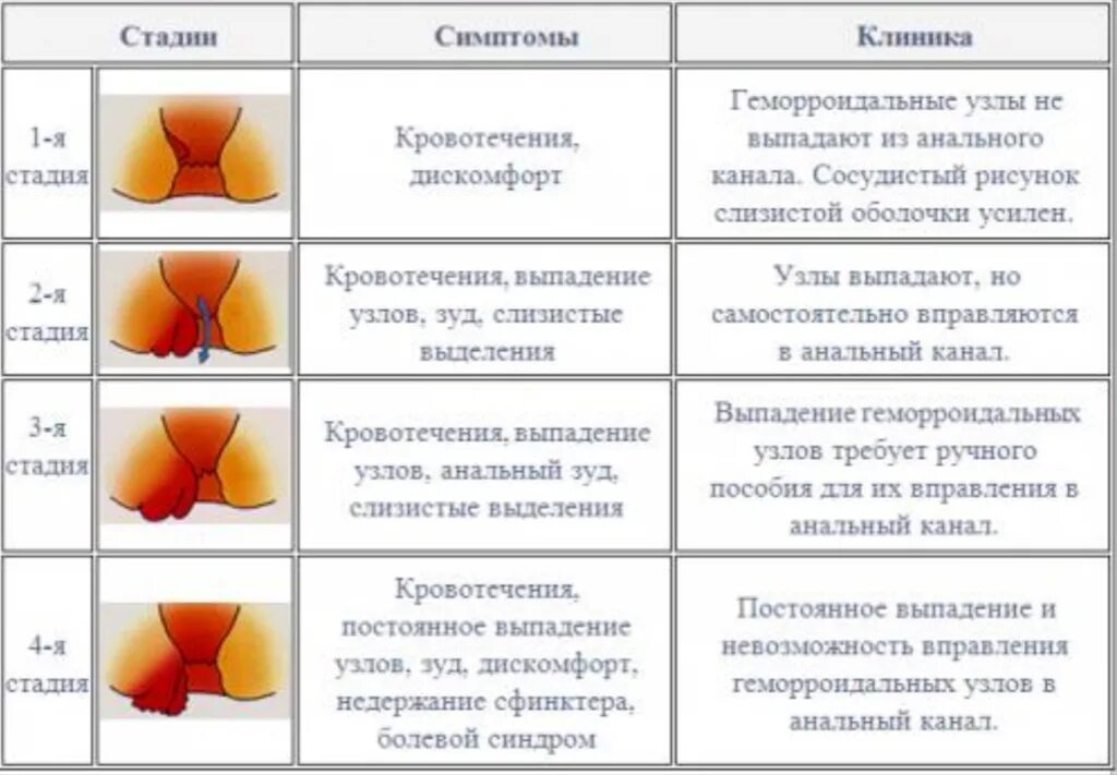 Почему геморрой при месячных. Геморрой наружный узел при беременности. стадии наружного геморроя схема. геморрой начальной стадии наружные узлы. наружный геморрой стадии.