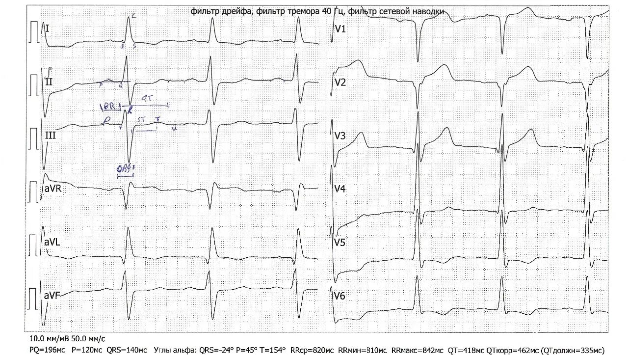 Наводка на ЭКГ. Нарушение реполяризации миокарда на ЭКГ. Нарушение процессов реполяризации на ЭКГ. Нарушения процессов реполяризации миокарда на ЭКГ. Нарушение реполяризации передне перегородочной области