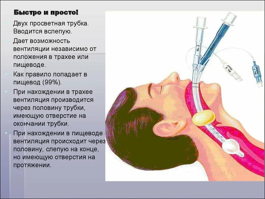 Через рот вводят. Интубационная трубка ИВЛ. Анестезия: эндотрахеальный наркоз.. Интубация трахеи эндотрахеальной трубкой.