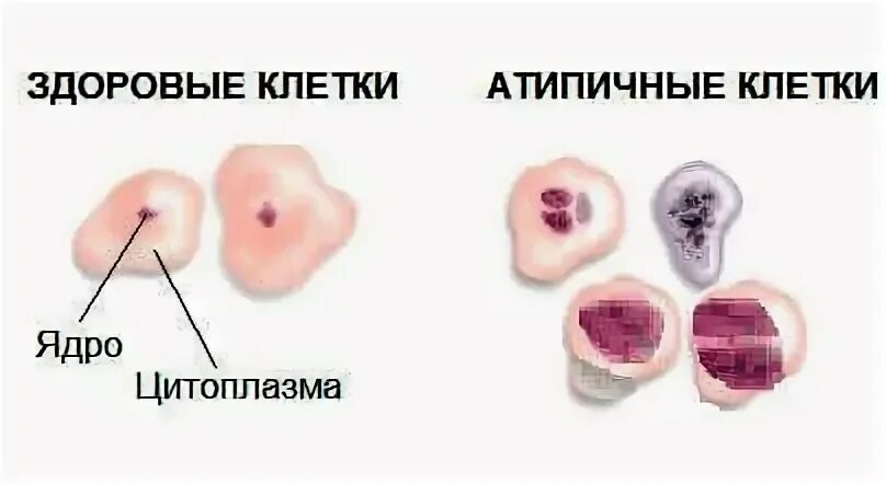 Атипия ядер клеток. Атипичные эпителиальные клетки. атипия клеток плоского эпителия шейки матки. цитологическое исследование на атипичные клетки. цитология шейки матки атипия.