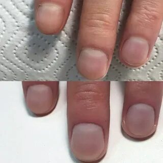 Как понять что ногтевая пластина
