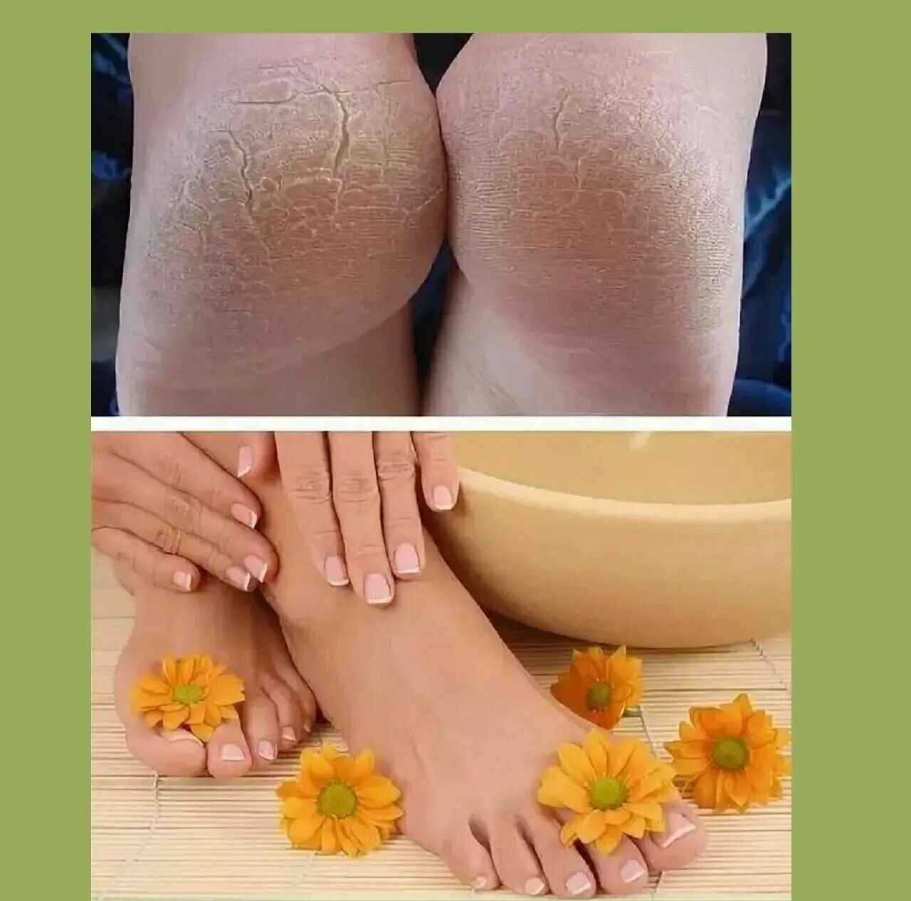 Раствор для ног от запаха. Намазал ноги чего делают. Избавление от натоптышей на стопе. Намазал ноги чего делают. Народные средства для ног.