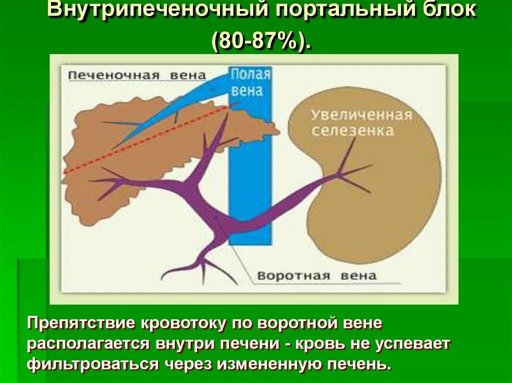 Расширение воротной вены. Телеангиэктазия портальная гипертензия. Коллатеральный кровоток воротной вены. Эуфиллин портальная гипертензия. Портальная гипертензия подпеченочный блок.