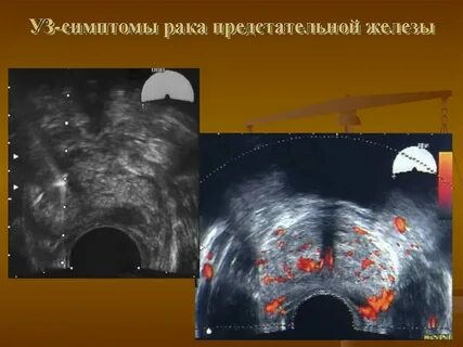 Что такое фиброз предстательной железы