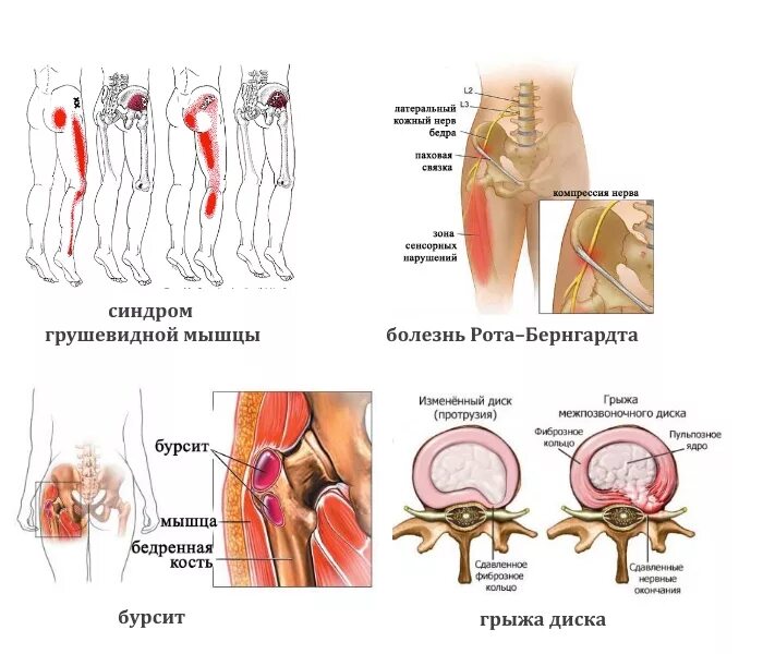 Болит правая ягодица и отдает в ногу