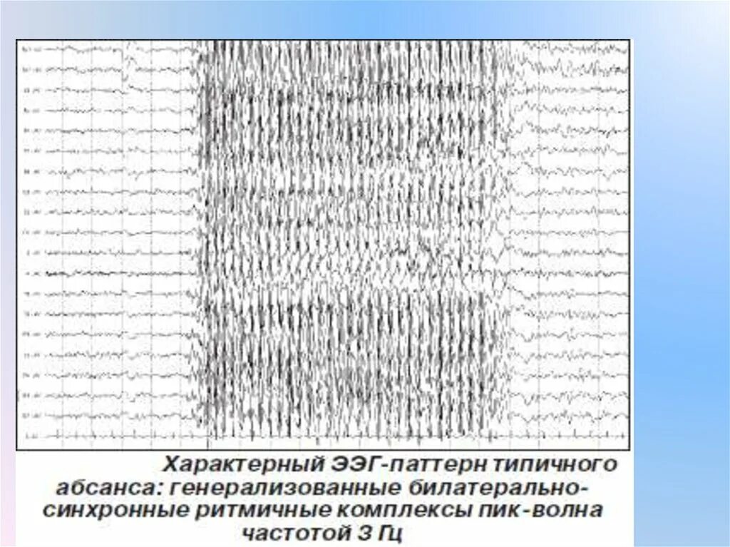 Ээг ответ. Генерализованные комплексы пик волна на ЭЭГ. ЭЭГ схема. ЭЭГ сигнал. Паттерн типичного абсанса на ЭЭГ.