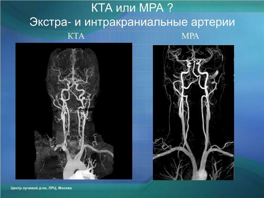 Интракраниальные артерии головного мозга. Кт-ангиография интракраниальных сосудов. Кт ангиография сонных артерий. Анатомия брахиоцефальных артерий кт. Мрт ангиография интракраниальных сосудов.