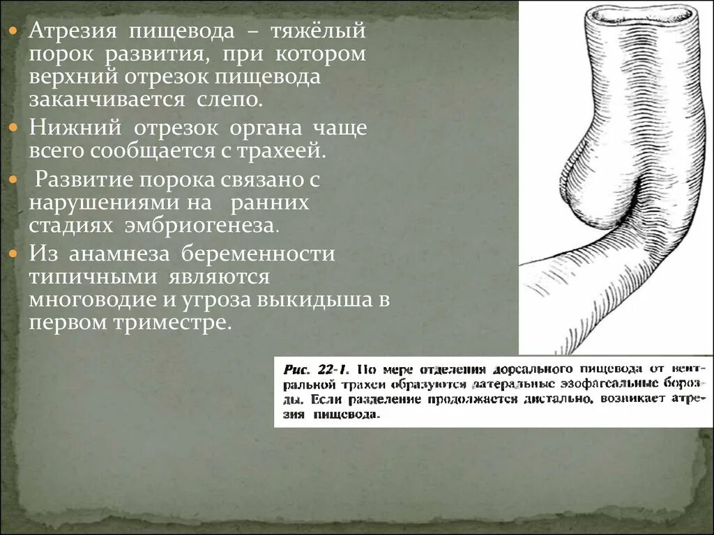 Атрезия пищевода презентация. Классификация атрезии пищевода у детей. Атрезия пищевода классификация. Слепой пищевод