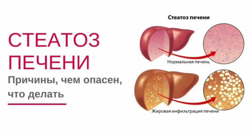 Стеатоз паренхимы печени что это