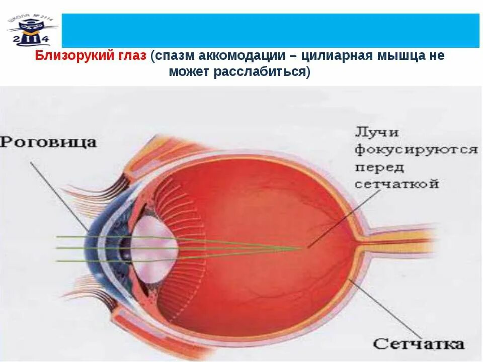 Ли спазм аккомодации. Миопия и спазм аккомодации. Близорукость (истинная и ложная формы патологии). Цилиарная мышца глаза спазм аккомодации. Спазм цилиарной мышцы.