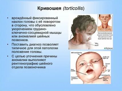 Врожденные пороки шеи