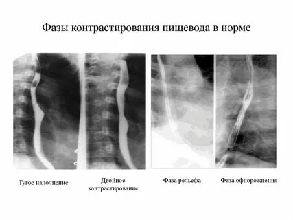 Контраст пищевода