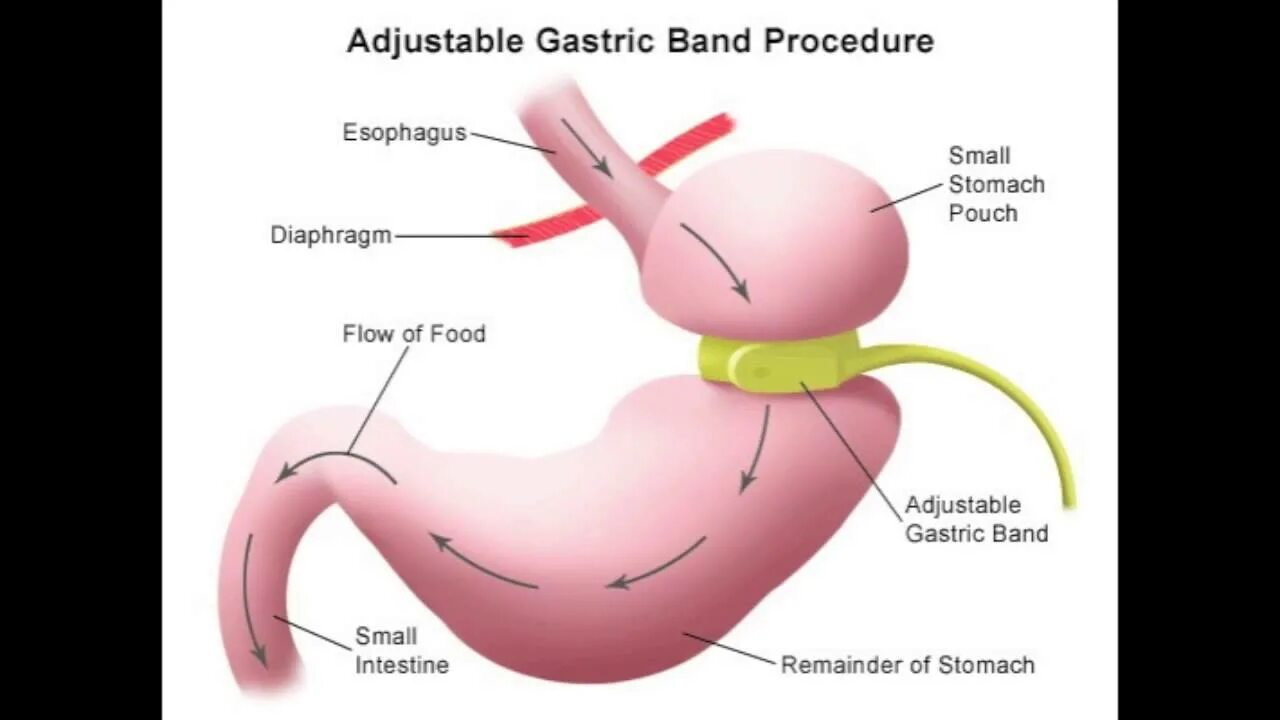 Кольцо на желудок для похудения. Лапароскопическое бандажирование желудка. Операция по уменьшению желудка. Операция кольцо на желудок для похудения.