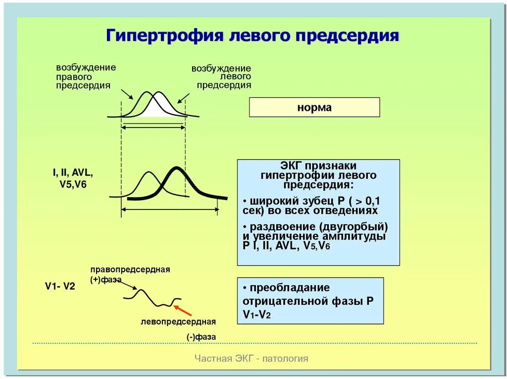 Гипертрофия левого предсердия на ЭКГ. Признаки гипертрофии левого предсердия на ЭКГ. ЭКГ - синдром гипертрофии предсердий.. Признаки гипертрофии левого предс. Норма правого предсердия