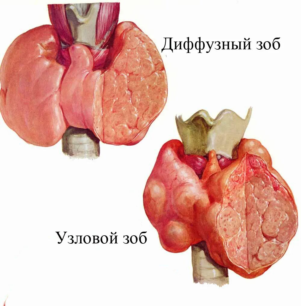 Узловая форма щитовидной железы. Диффузно-Узловой зоб макропрепарат. Узловая Струма щитовидной железы что это такое. Диффузный токсический зоб и многоузловой зоб.