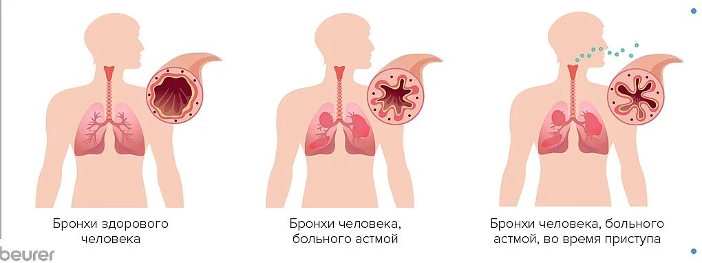 Могут ли положить в больницу с бронхитом