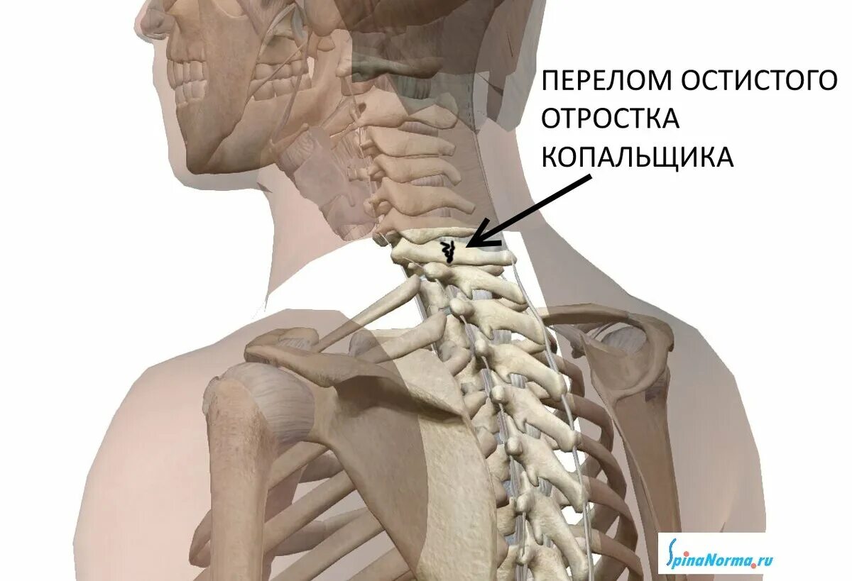 Перелом отростка поясничного позвонка. Перелом отростка поясничного позвонка
