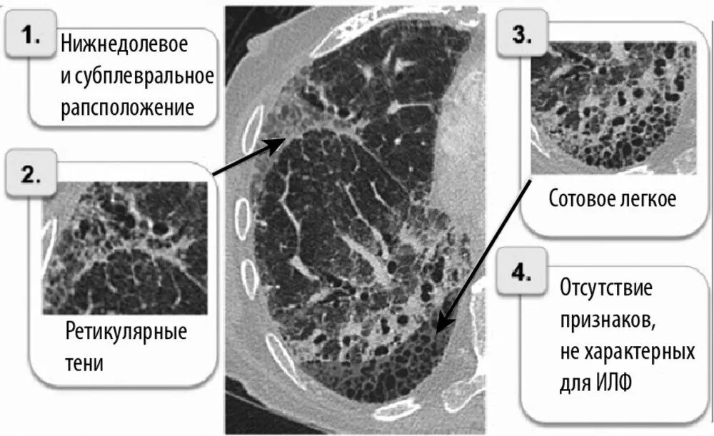 Что означает фиброзное изменение. Идиопатический легочный фиброз кт. Идиопатический фиброз кт кт. Паракостальный фиброз. Идиопатический легочный фиброз кт признаки.
