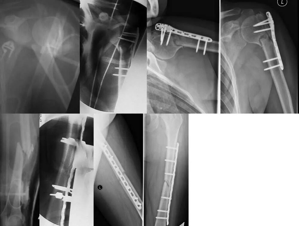 Остеосинтез операция пластины. Остеосинтез титановой пластиной. Остеосинтез плечевой кости рентген. Остеосинтез титановой пластиной ключицы. Накостный остеосинтез плечевой кости.