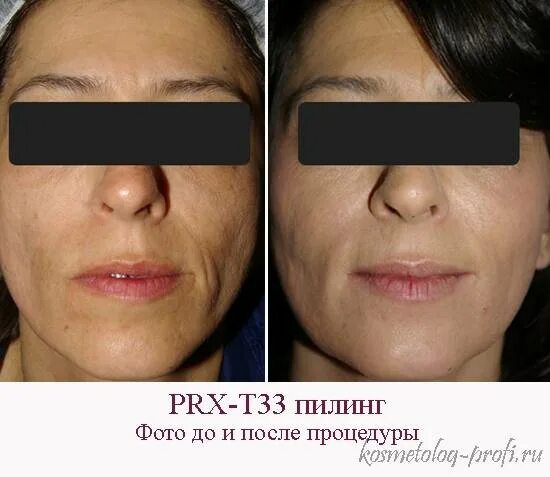 Пилинг prx отзывы. Пилинг rxt 33.